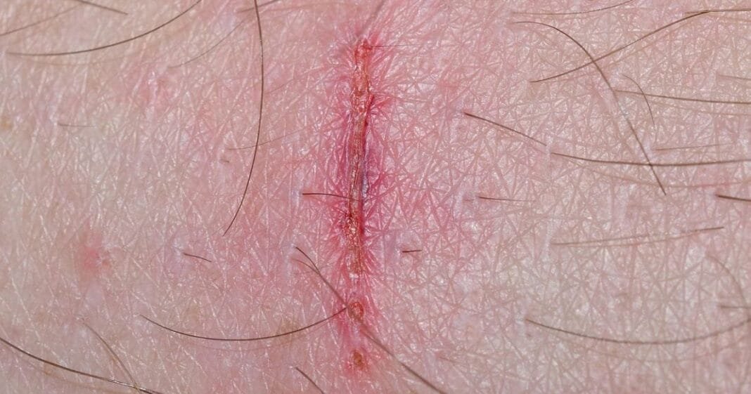 Could Hemp Seed Oil Help Heal Wounds?