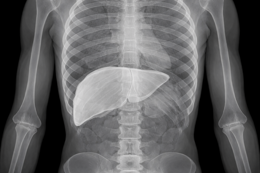 Study suggests CBD and CBG could be treatment for a common chronic liver disease